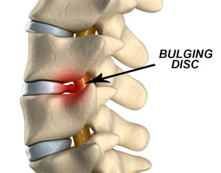 Can a Car Accident Cause a Bulging Disc?