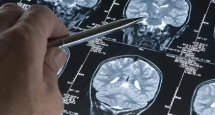 Steps to Take Immediately After a Brain Injury