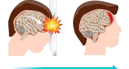 Types of Accidents That Can Cause Brain Injuries