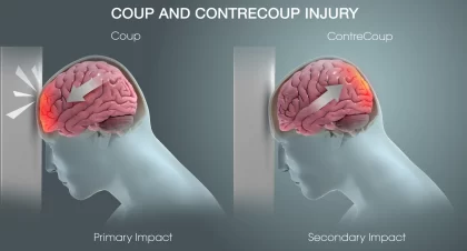 Understanding Traumatic Brain Injuries
