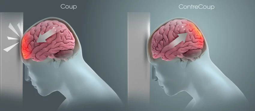 Understanding Traumatic Brain Injuries-image