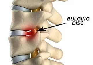 Can a Car Accident Cause a Bulging Disc?