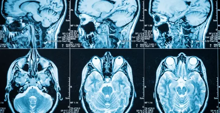 Concussions in Children: What Parents Should Know-image
