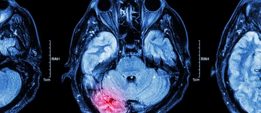 Understanding Traumatic Brain Injuries-image